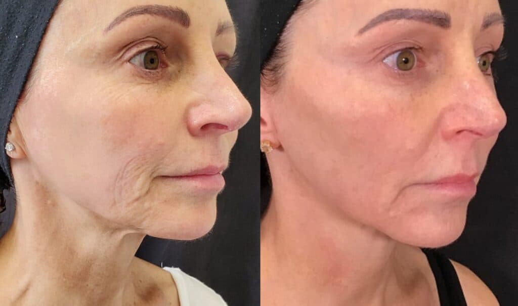 Discover Morpheus8 Treatment Near You Sapron Laser & Beauty Spa